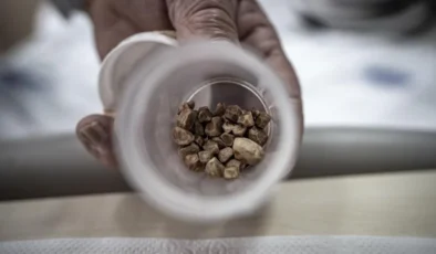 Erzurum’da Tıp Literatürüne Geçecek Vaka: İdrar Kanalından Tam 51 Taş Çıkarıldı!