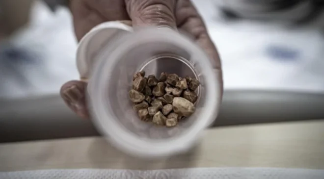 Erzurum’da Tıp Literatürüne Geçecek Vaka: İdrar Kanalından Tam 51 Taş Çıkarıldı!