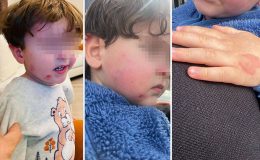 Bursa’da Kreş Skandalı: Küçük Çocuktaki Darp İzleri Aileyi Ayağa Kaldırdı!