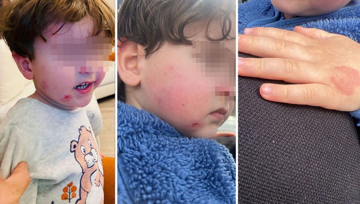 Bursa’da Kreş Skandalı: Küçük Çocuktaki Darp İzleri Aileyi Ayağa Kaldırdı!