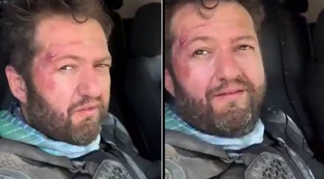 “Nalet Bebe” Lakaplı Ömer Başdoğan Motosiklet Kazası Geçirdi! Yüzündeki Yaralar Dikkate Çekti