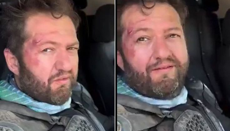 “Nalet Bebe” Lakaplı Ömer Başdoğan Motosiklet Kazası Geçirdi! Yüzündeki Yaralar Dikkate Çekti